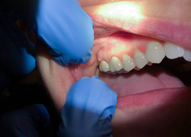 Best Urgent Tooth Repair  in Marionville, MO